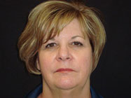 Palmgren Acupuncture - After 10 Sessions of Facial Rejuvenation